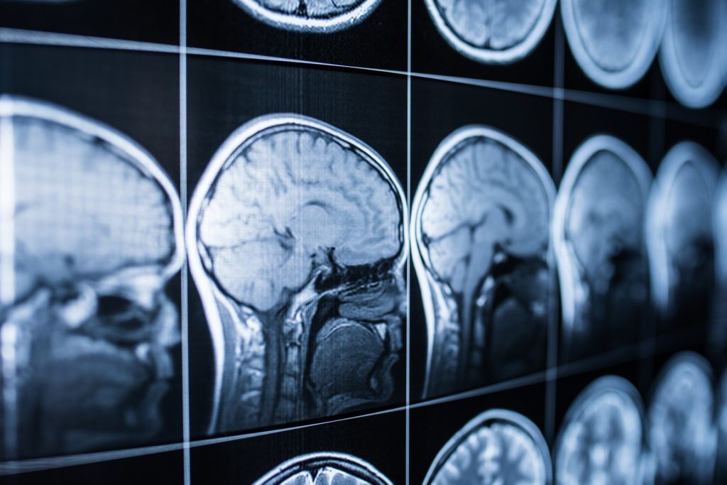 Radiografía de la cabeza y el cerebro de una persona